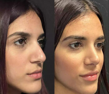 septoplasty in dubai