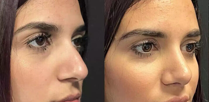 septoplasty in dubai