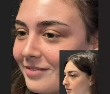 rhinoplasty in dubai