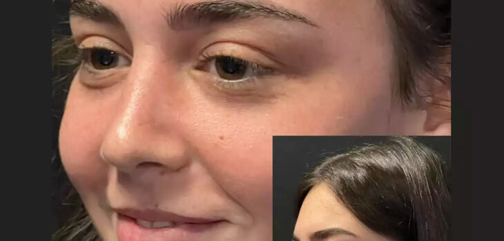 rhinoplasty in dubai