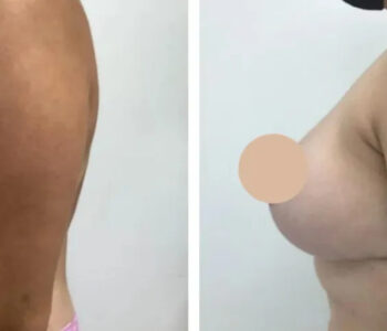 breast reduction in dubai