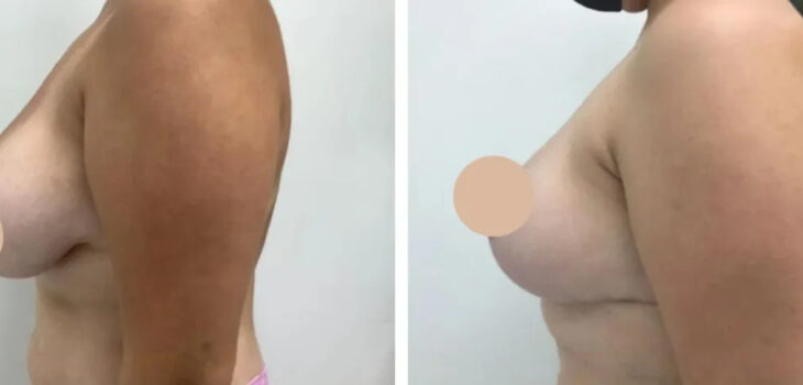 breast reduction in dubai