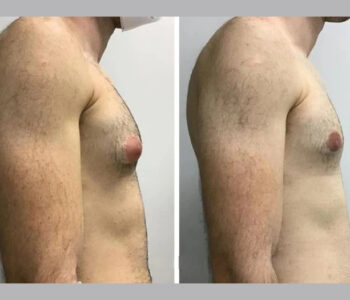 gynecomastia in dubai