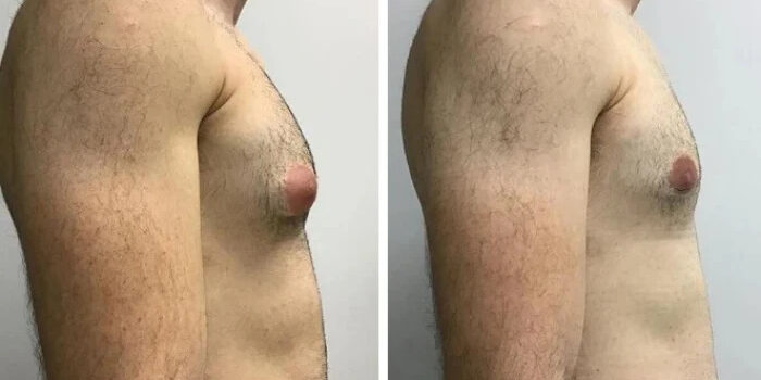 gynecomastia in dubai