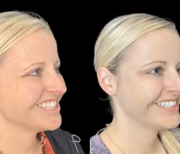 Discover the Benefits of Botox Treatment in Dubai