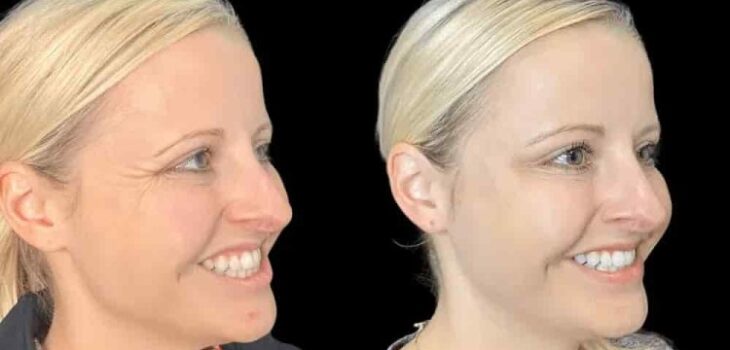 Discover the Benefits of Botox Treatment in Dubai