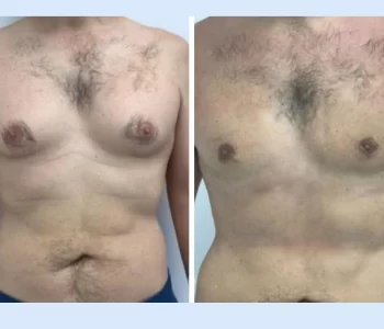 gynecomastia in dubai