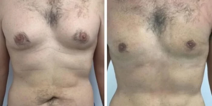gynecomastia in dubai