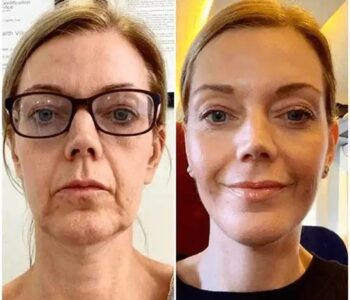 Profhilo treatment in dubai