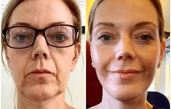 Profhilo treatment in dubai