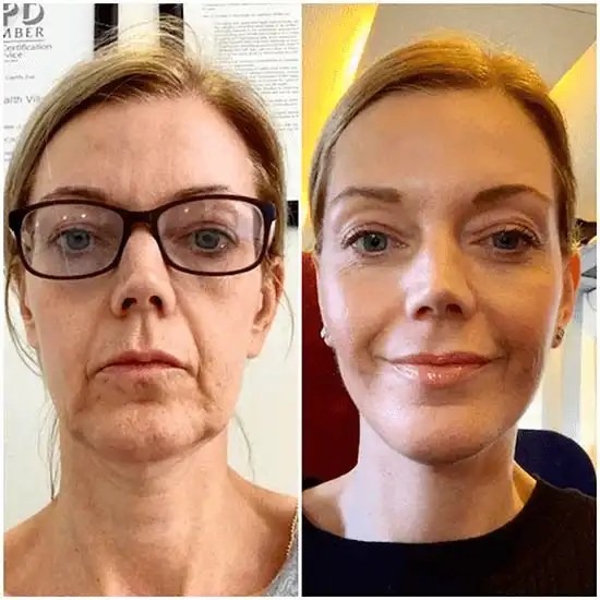 Profhilo treatment in dubai