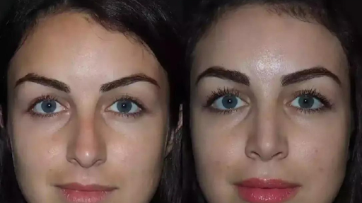 septoplasty in dubai