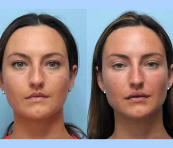Is Thread Lift Treatment in Dubai Worth the Investment