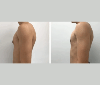 Gynecomastia surgery