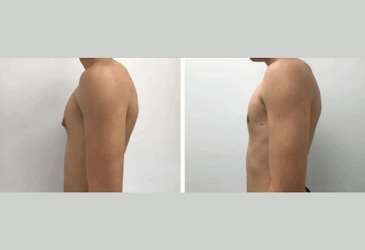 Gynecomastia surgery