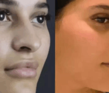 rhinoplasty in dubai
