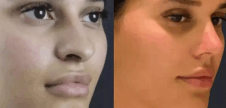 rhinoplasty in dubai